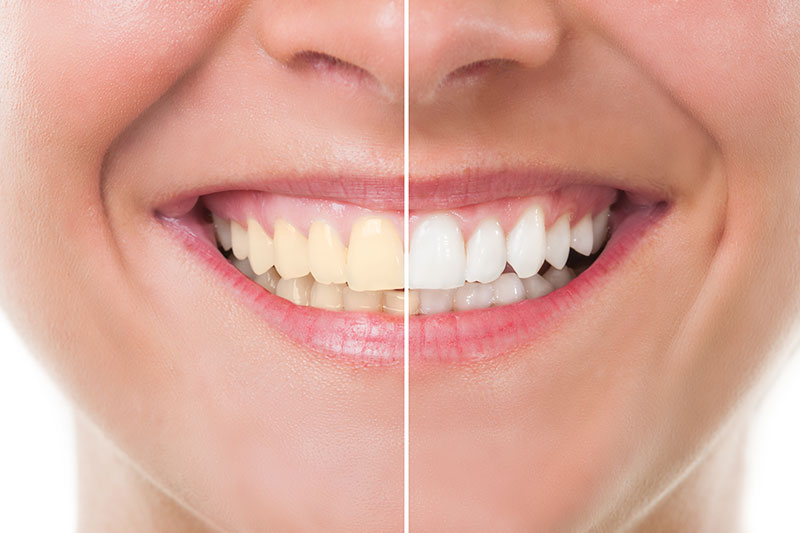 cost teeth whitening